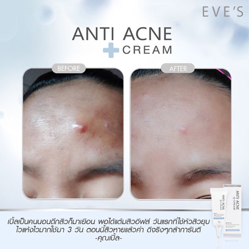 eves-ครีมแต้มสิว-ลดอาการบวมแดงของสิว