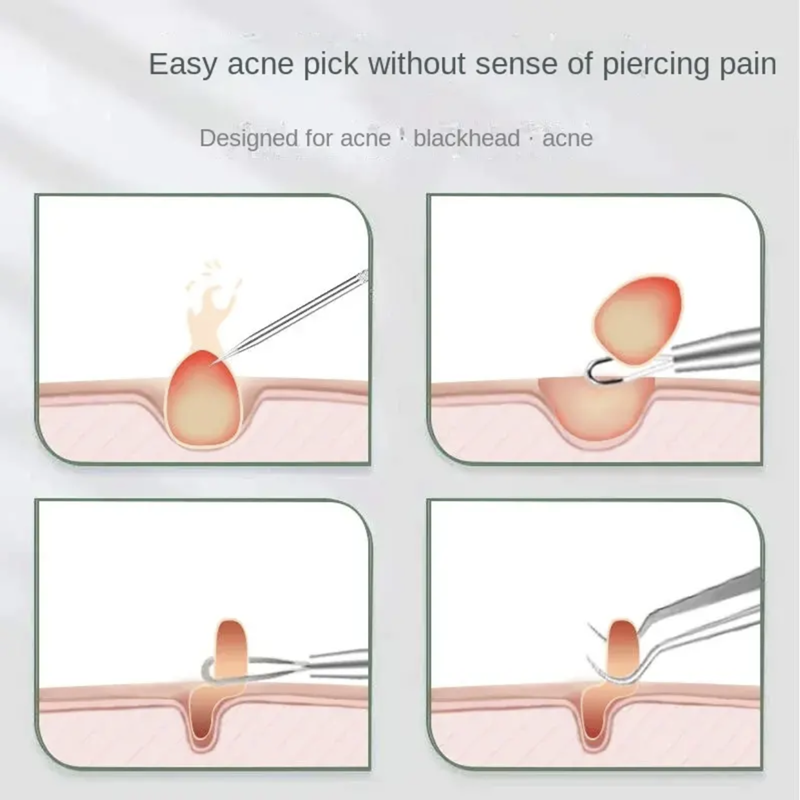 ชุดเข็มสิวหัวดำ-ชุดเครื่องมือรักษาสิว-ชุด-4ชิ้น-ชุดเครื่องมือทำความสะอาดสิวสแตนเลส