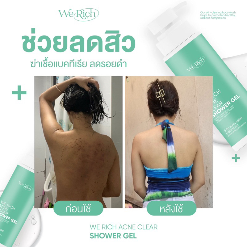 ส่งฟรี-ของแท้-เจลอาบน้ำ-ลดสิว-ผิวใส-ครีมอาบน้ำ-สิวหลัง-ผิวขาว