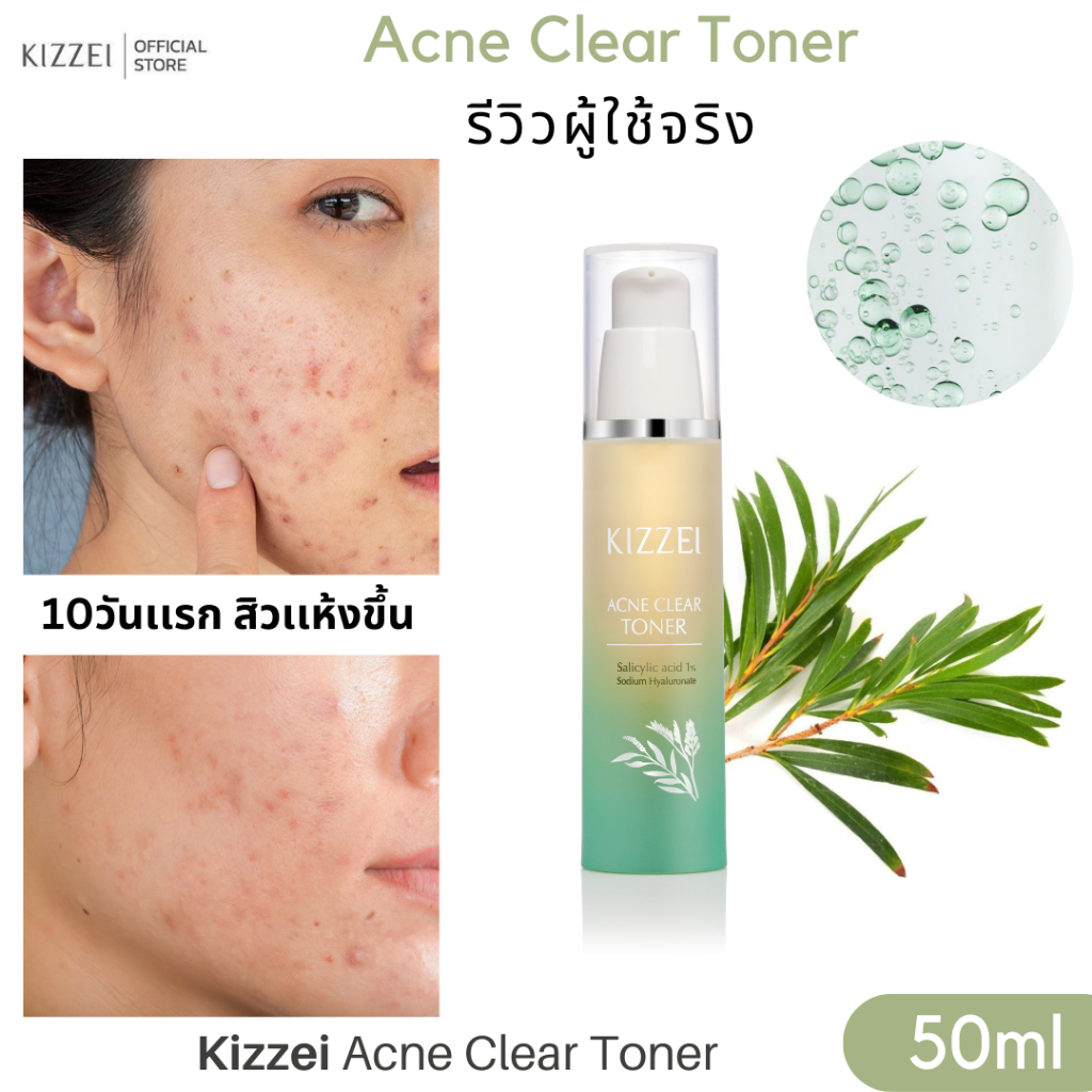 เห็นผลใน2อาทิตย์-kizzei-acne-clear-toner-50ml-โทนเนอร์ลดสิว-สิวอุดตัน-สิวอักเสบ-รูขุมขนกว้าง-ลดหน้ามัน-สิวเสี้ยน-สิวผด