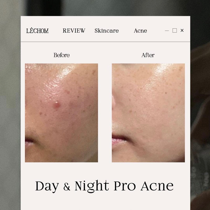 แพ็คเกจใหม่-เลอโฉม-day-amp-night-pro-acne-เซรั่มเดย์-amp-ไนท์-เลอโฉมสูตรใหม่-เน้นลดสิว-ลดสิวอักเสบ-ลดรอยดำรอยแดงจากสิวได้ดี