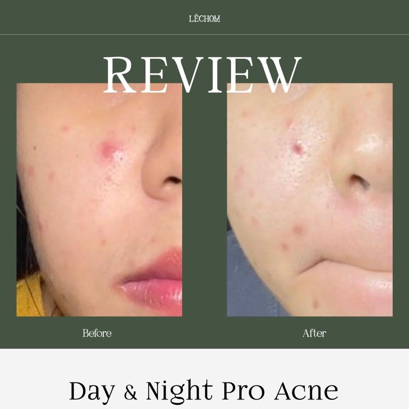 แพ็คเกจใหม่-เลอโฉม-day-amp-night-pro-acne-เซรั่มเดย์-amp-ไนท์-เลอโฉมสูตรใหม่-เน้นลดสิว-ลดสิวอักเสบ-ลดรอยดำรอยแดงจากสิวได้ดี