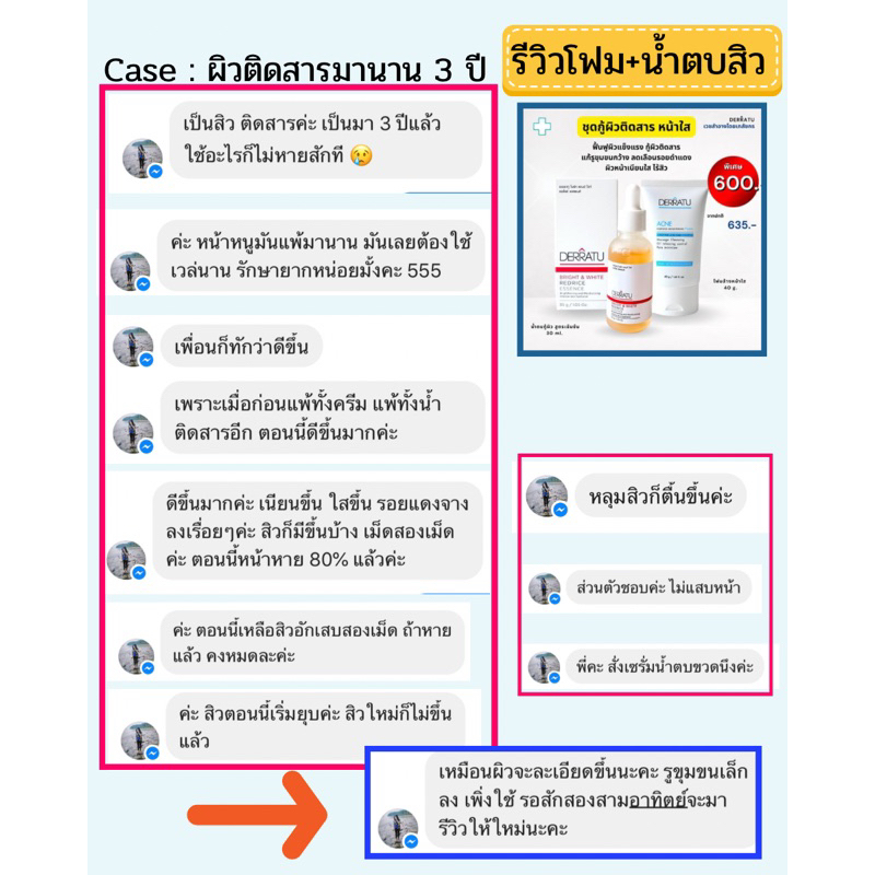 รักษาสิวสเตียรอยด์-derratu-ชุดต้านผิวติดสาร-หน้าใส-แก้อุดตันเรื้อรัง-ฟื้นฟูผิวแข็งแรง-หน้าใสไกลสิว