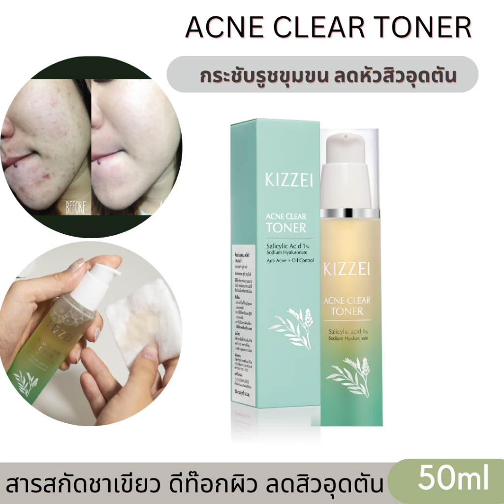 เห็นผลใน2อาทิตย์-kizzei-acne-clear-toner-50ml-โทนเนอร์ลดสิว-สิวอุดตัน-สิวอักเสบ-รูขุมขนกว้าง-ลดหน้ามัน-สิวเสี้ยน-สิวผด