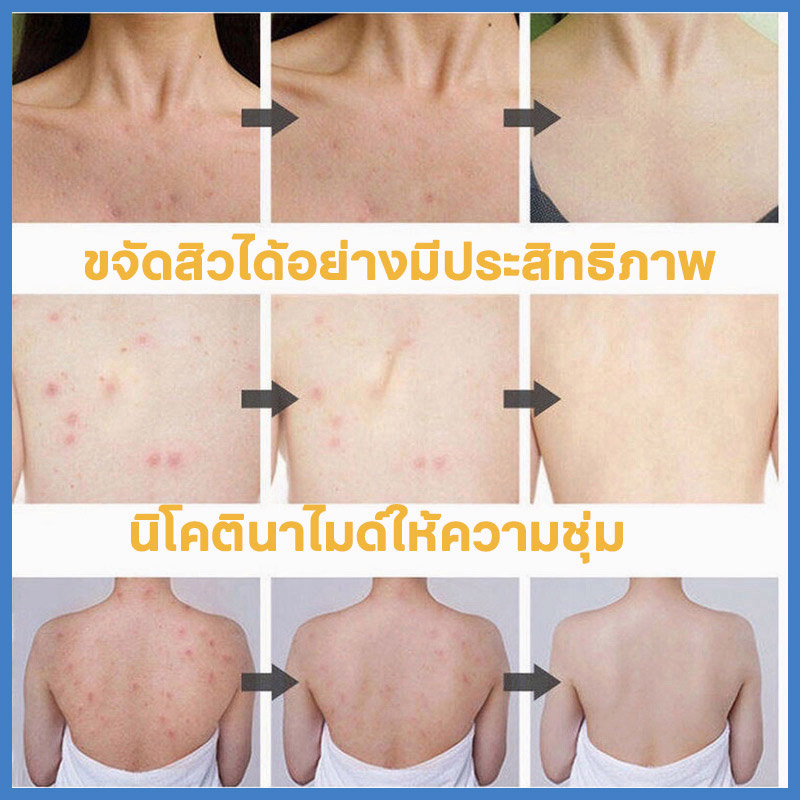 สบู่ลดสิว-ครีมอาบน้ำ-สบู่ไวท์เทนนิ่ง-300ml-ครีมอาบน้ําโฟมเยอะ-รักษาสิว-สบู่ลดสิวที่หลัง-เจลอาบน้ำ-ผิวขาว-ลอกสิวเสี้ยน