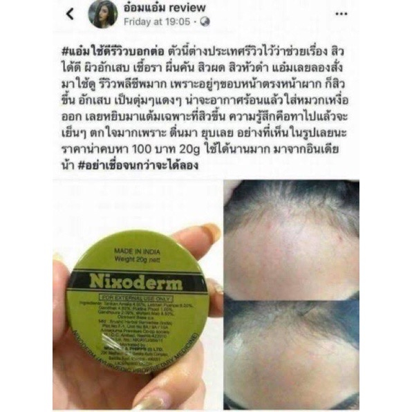 nixoderm-ครีมรักษาสิวอักเสบ-สิวอุดตัน-กลากเกลื้อน-บรรเทาอาการคันจากเชื้อราและคันตามผิวหนัง