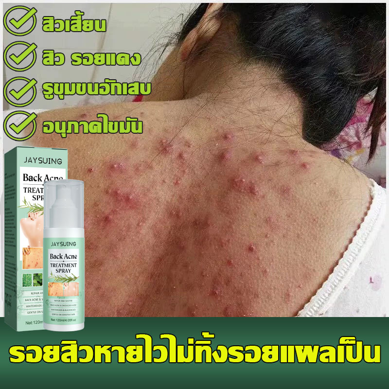 jaysuing-120ml-สิวที่หลัง-แอคเน่-สเปรย์ฉีดแผ่นหลังและลำตัว-ลดไรและสิวตามร่างกาย-กำจัดสิวที่หลังและลำตัว-ครีมแต้มสิว