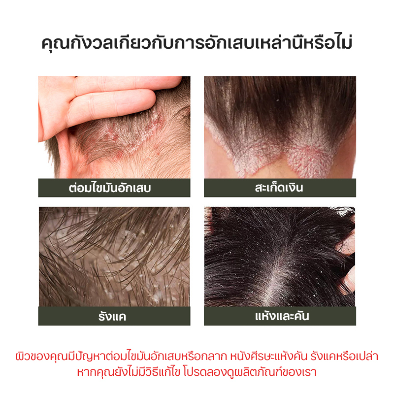 ครีมทา-กลากเกลื้อน-ลดอาการคัน-โรคผิวหนัง-ครีมต้านเชื้อแบคทีเรีย-เชื้อรา-กลาก-เกลื้อน-ผิวหนังอักเสบ-ลดอาการผื่น-พกพาสะดวก