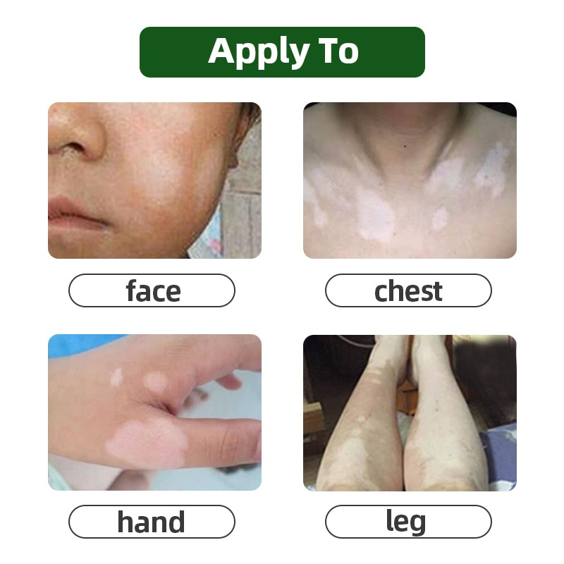 ในสต็อก-โปรโมชั่น-ผิวด่างขาวครีมสมุนไพรจีน-vitiligo-health-creamช่วยได้