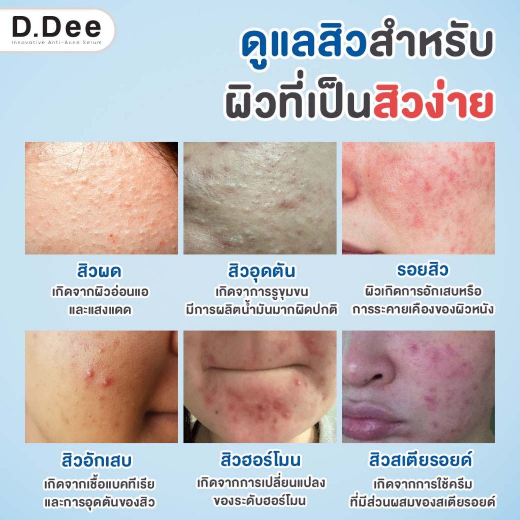 เซ็ทคู่รักษาสิว-d-dee-เซรั่มรักษาสิวและเจลแต้มสิว-แนะนำสำหรับคนที่เป็น-สิวเรื้อรัง-สิวอักเสบ-สิวอุดตัน-สิวผด-สิวแพ้สาร