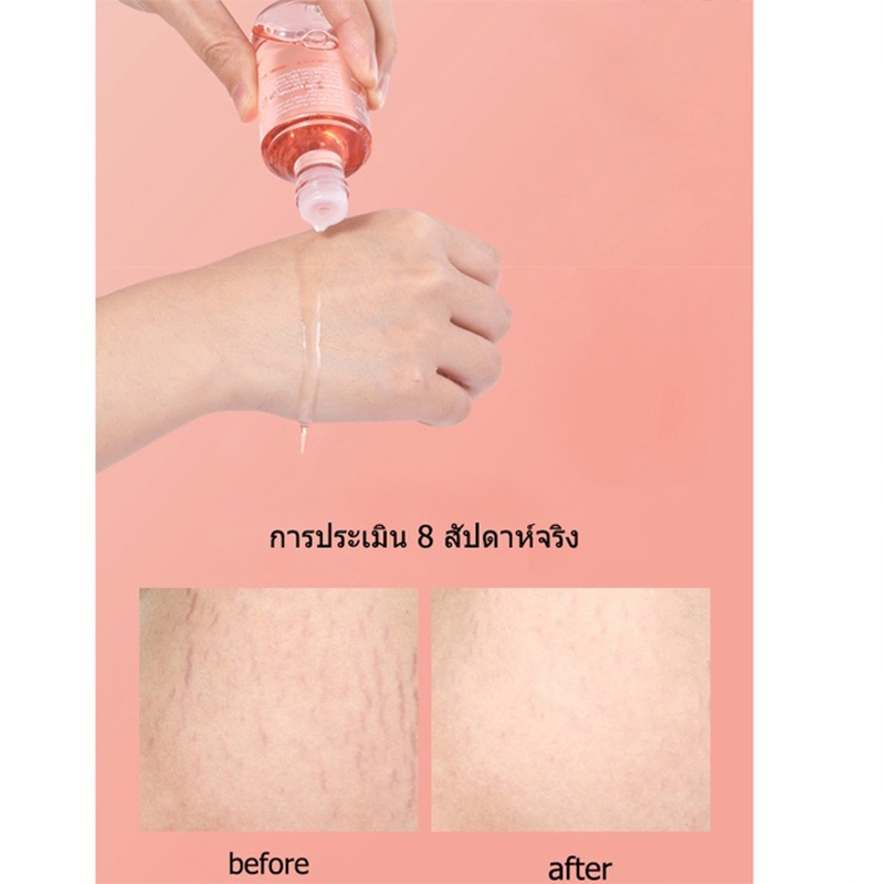 bio-oil-200ml-ไบโอออยล์-ลดรอยแตกลาย-สีผิวไม่สม่ำเสมอ-ลดเลือนรอยแผลเป็น-ผิวแตกลาย-ให้ดูจางลง-บำรุงผิว-ป้องกันรอยแตกลาย