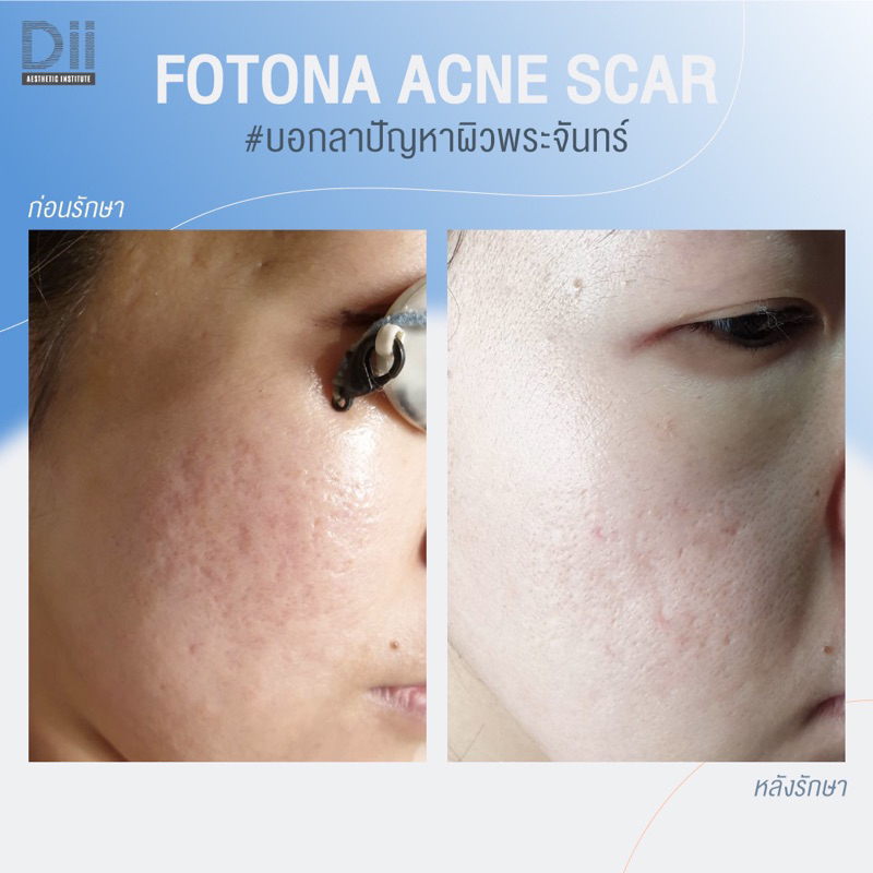 dii-aesthetic-fotona-acne-scar-เลเซอร์รักษาหลุมสิว