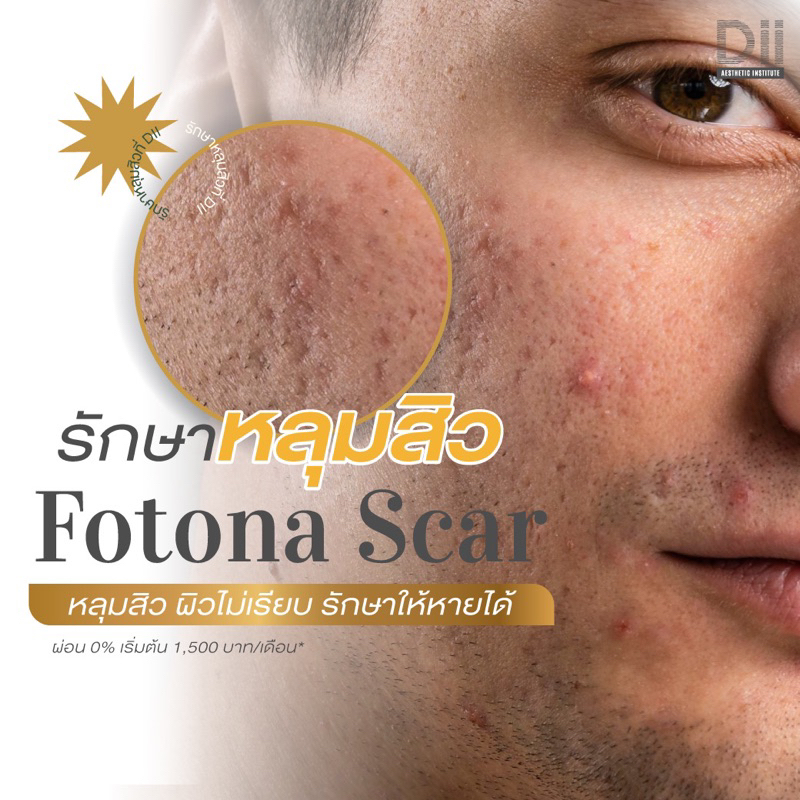 dii-aesthetic-fotona-acne-scar-เลเซอร์รักษาหลุมสิว