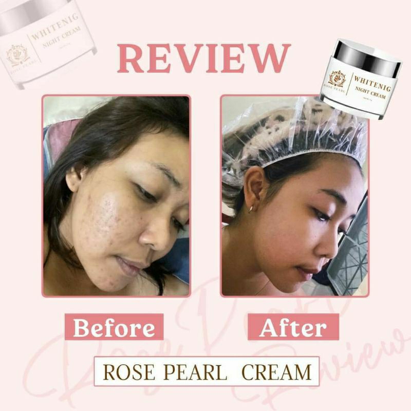 ครีมโรสเพิร์ล-rosepearl-ครีมขาวใส-ลดสิว-ฝ้า-กระ-จุดด่างดำ-ชุ่มชื้นและช่วยลดการเกิดสิวอุดตันทำให้สิวยุบไว