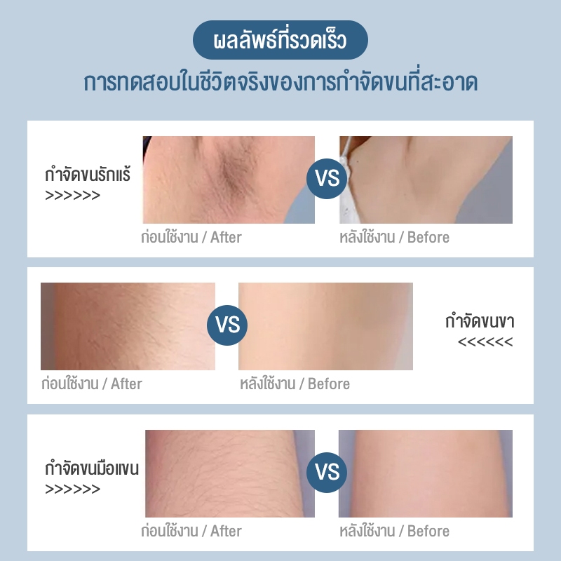 biaowang-อุปกรณ์กำจัดขนด้วยเลเซอร์จุดเยือกแข็งไม่ได้โกนขนรักแร้อย่างถาวรเครื่องกำจัดขนทั้งตัวของผู้หญิงเครื่องกำจัดขนในค