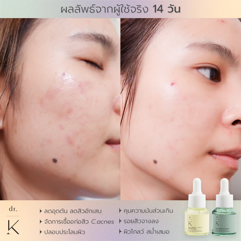 เซรั่มสิว-หมอเก่ง-dr-k-super-sensitive-acne-serum-เซรั่มลดสิว-สูตรอ่อนโยน-สำหรับผิวแพ้ง่าย