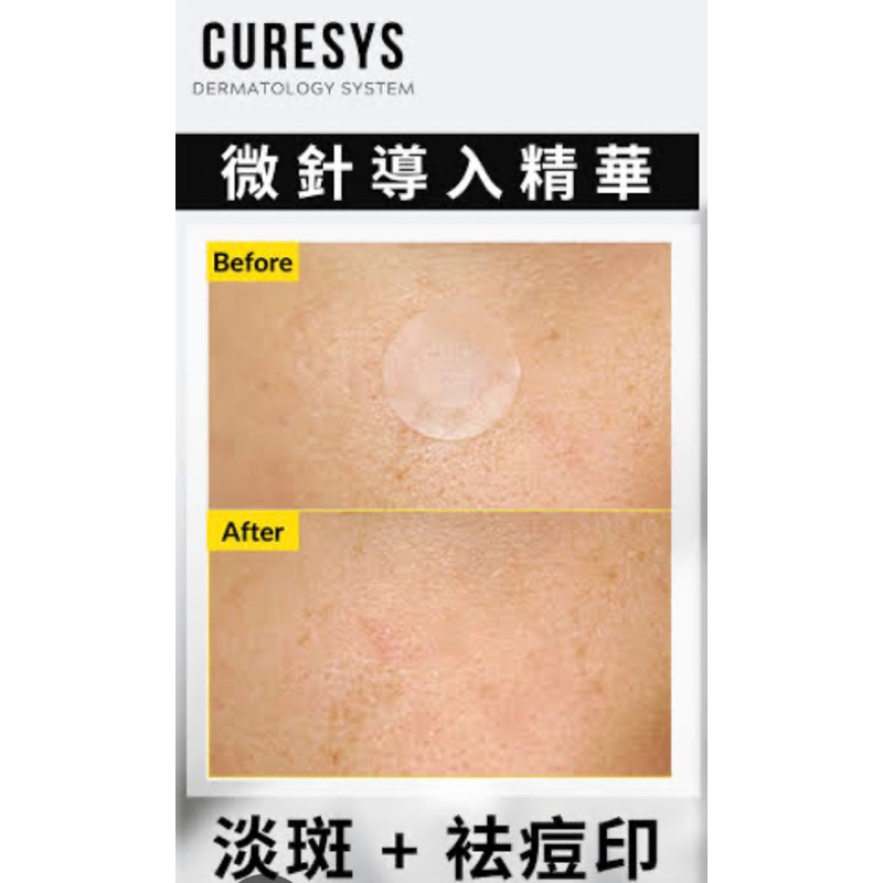 แผ่นแปะสิว CURESYS Dark Spot Patch - Micro cystal พร้อมส่งจากไทย ...