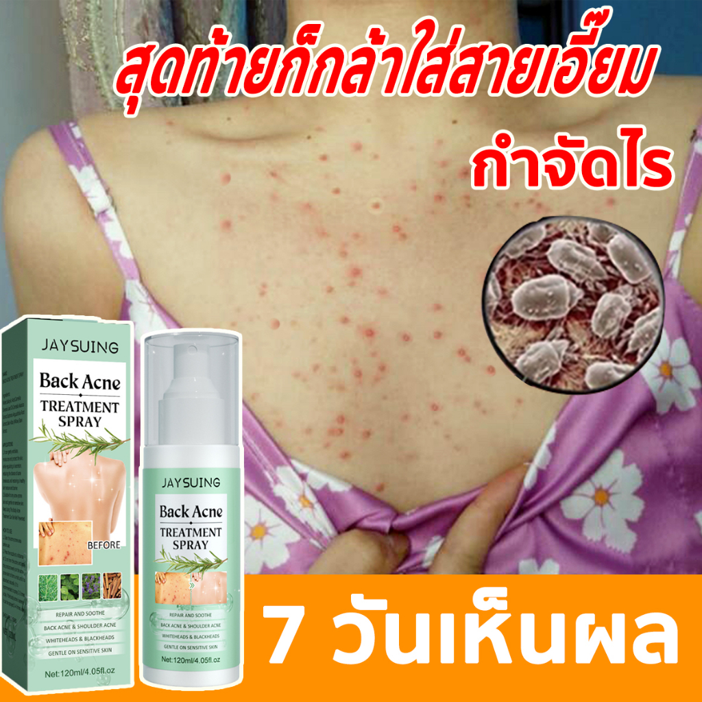 JAYSUING สเปรย์รักษาสิวที่หลัง สิวหน้าอก สิวใบหน้า สูตรแพทย์แผนไทย Acne