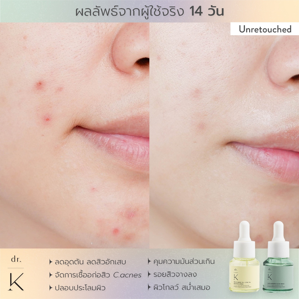 เซรั่มสิว-หมอเก่ง-dr-k-super-sensitive-acne-serum-เซรั่มลดสิว-สูตรอ่อนโยน-สำหรับผิวแพ้ง่าย