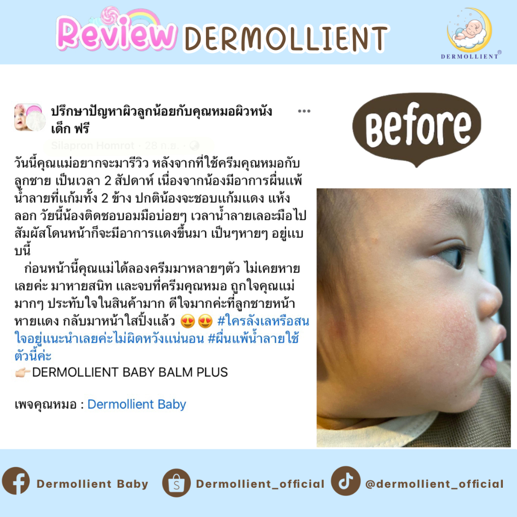 บาล์มสำหรับเด็กผิวแพ้ง่าย-25-กรัม-โดยแพทย์ผิวหนังเด็ก-dermollient-baby-balm-plus