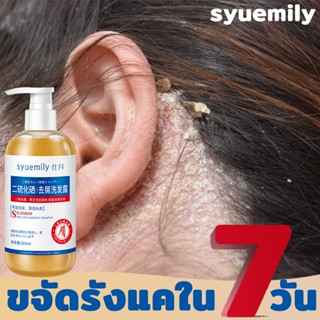 1ขวด แก้ปัญหาเส้นผม SHIYUE ยาสระผมเชื้อรา 300ML ป้องกันรังแคและลดความมัน  ลดอาการคันศีรษะ แชมพูขจัดรังแค ยาสระผมรังแค