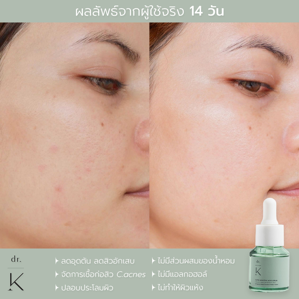 เซรั่มสิว-หมอเก่ง-dr-k-super-sensitive-acne-serum-เซรั่มลดสิว-สูตรอ่อนโยน-สำหรับผิวแพ้ง่าย