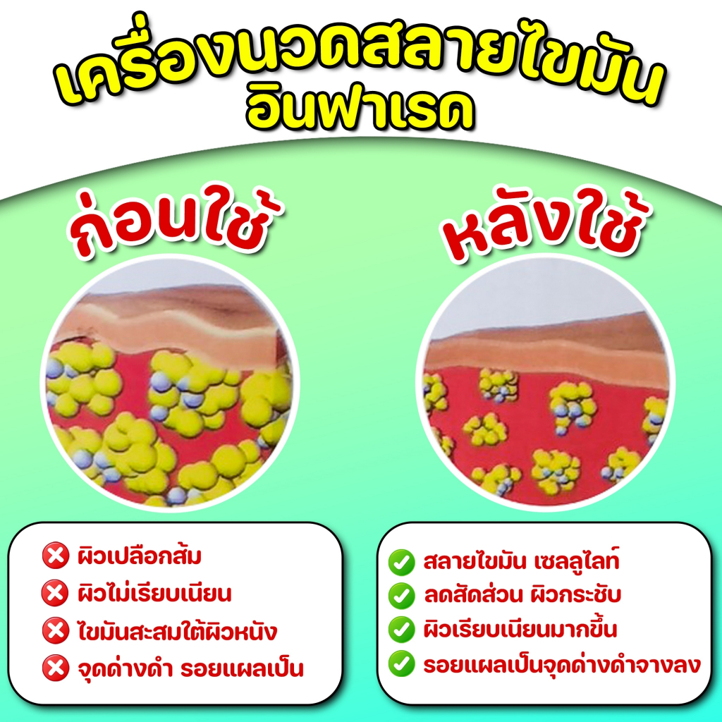 ส่งฟรี-เครื่องนวดสลายไขมัน-benice-นวดปวดเมื่อย-ผ่อนคลาย-ตามลำตัว-สลายไขมัน-กระตุ้นการสร้างคอลลาเจน