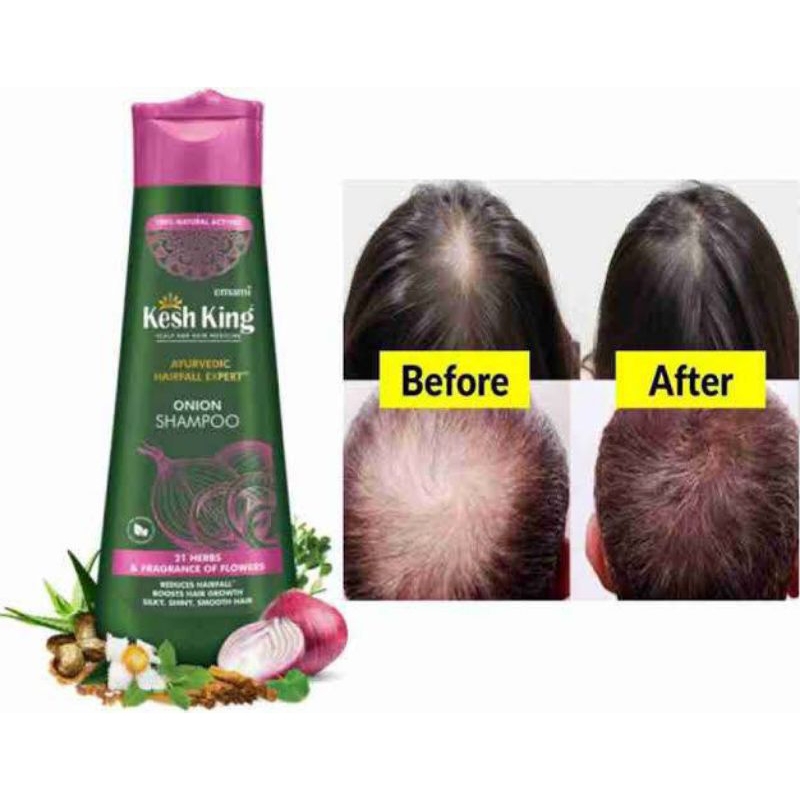 kesh-king-organic-onion-shampoo-with-curry-leaves-reduces-hair-full-upto-98-200-ml