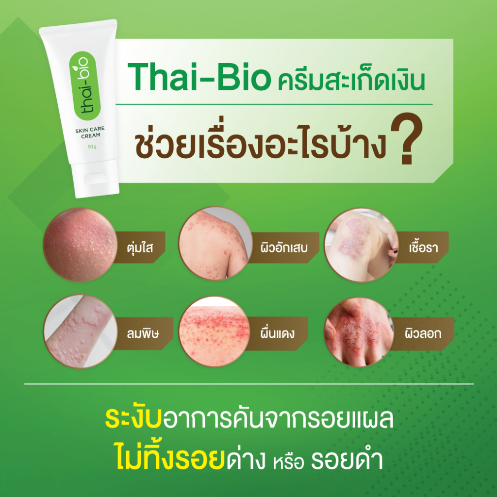 ส่งฟรี-522-10ddxoctw5-สะเก็ดเงิน-โรคสะเก็ดเงิน-thai-bio-ครีมทาโรคสะเก็ดเงิน-thai-bio-ครีมสะเก็ดเงิน-50-g