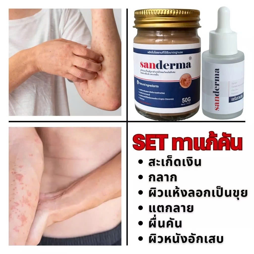 COMBO CREAM & SERUM SANDERMA เชี่ยวชาญเฉพาะด้าน โรคผิวหนังทุกชนิด โรค ...