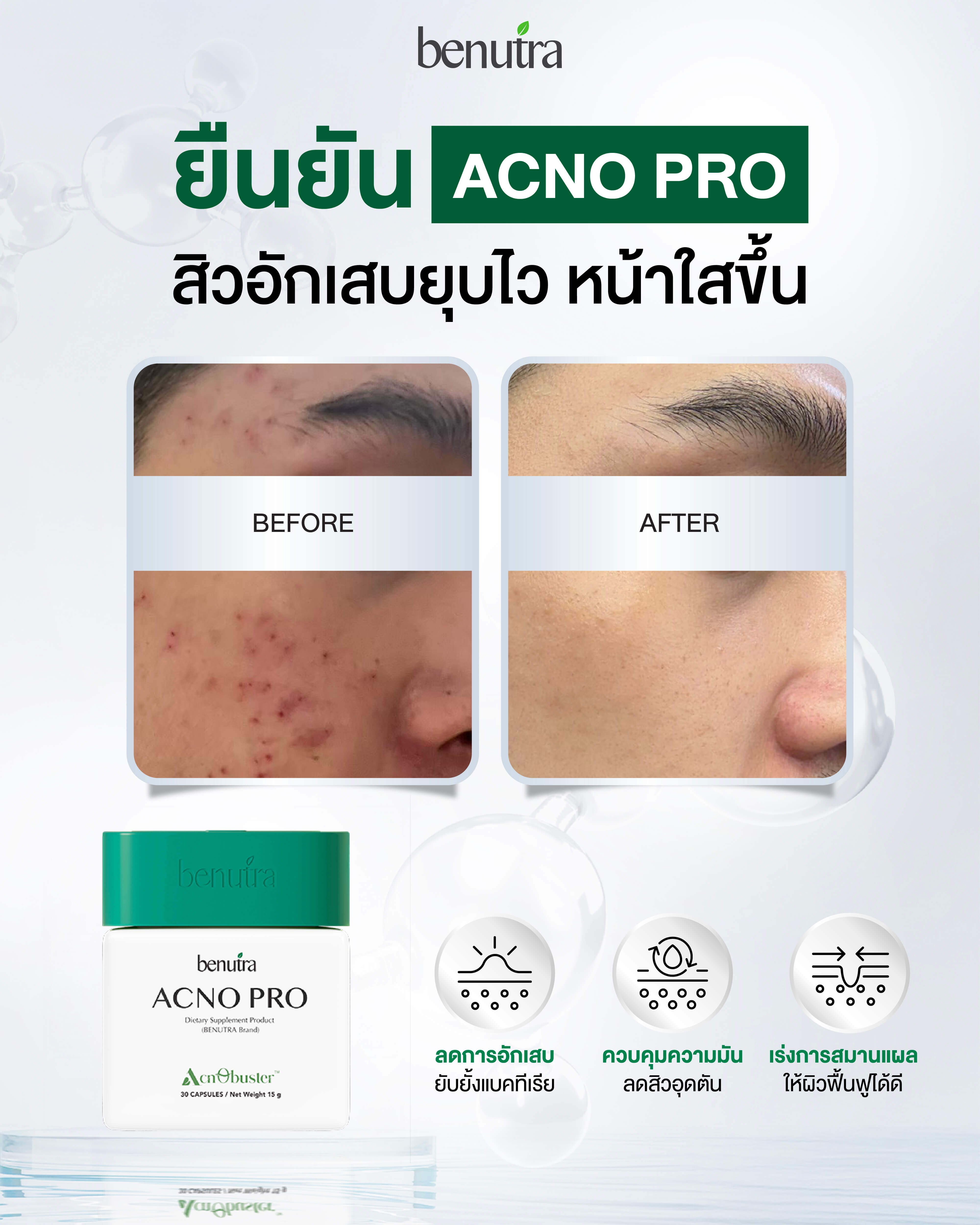 Benutra Acno Pro 1 กล่อง 30 ม. บีนูทร่า แอคโน โปร วิตามินลดสิว ซิงค์ลด ...