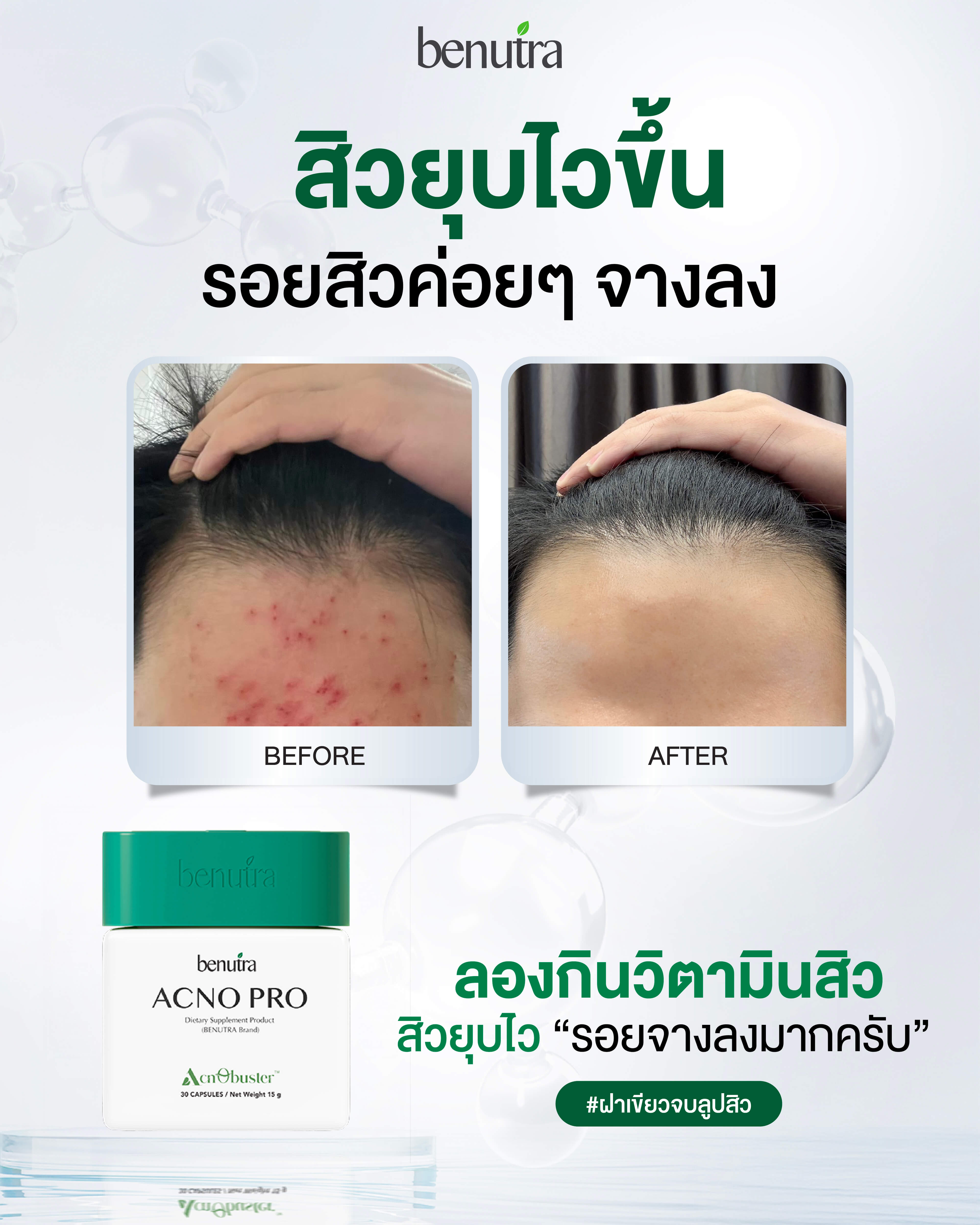 Benutra Acno Pro 2 กล่อง บีนูทร่า แอคโน โปร วิตามินลดสิว ซิงค์ลดสิว สิว ...