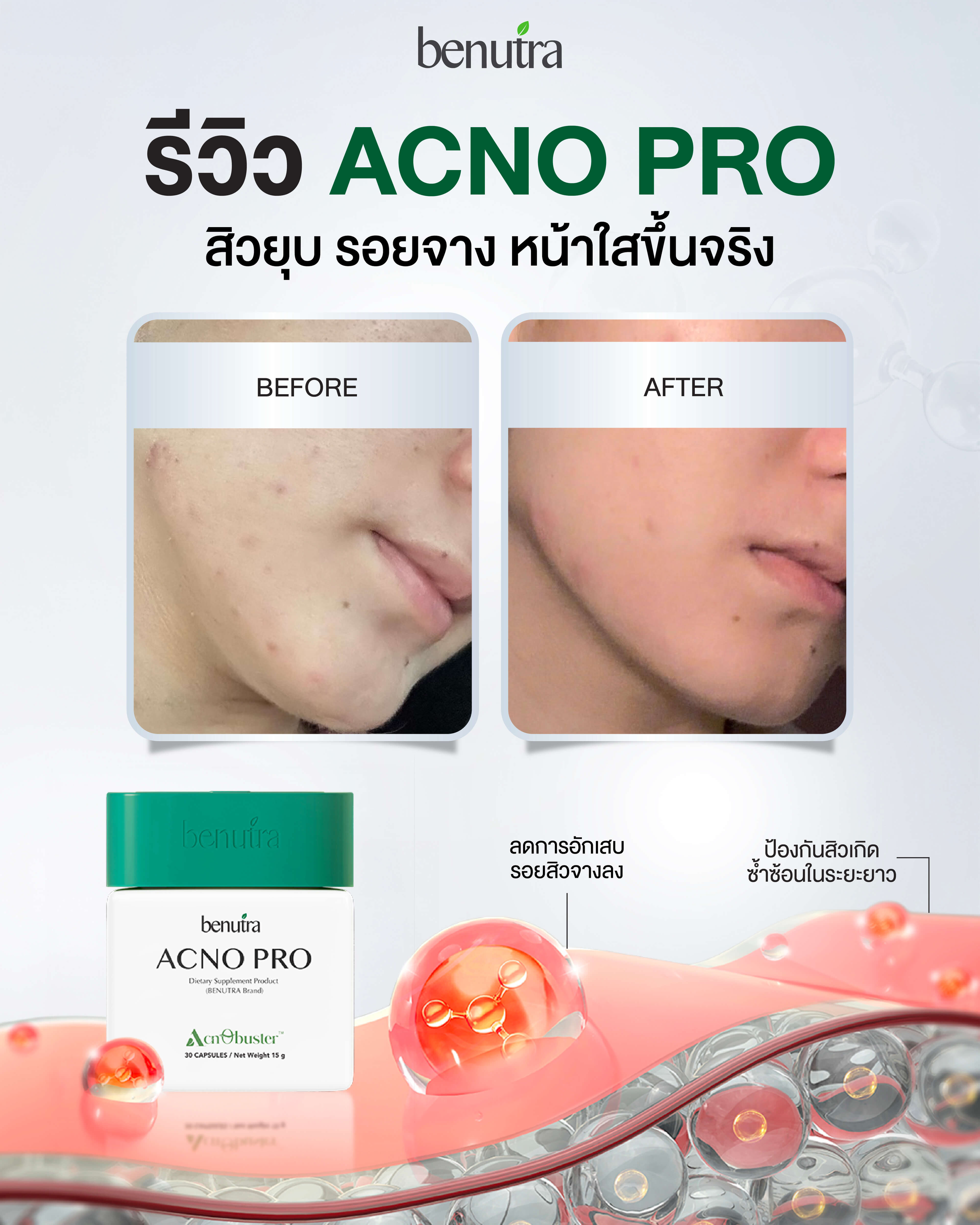 BENUTRA ACNO PRO 1 กระปุก 30 เม็ด บีนูทร่า แอคโน โปร วิตามินลดสิว ซิงค์ ...