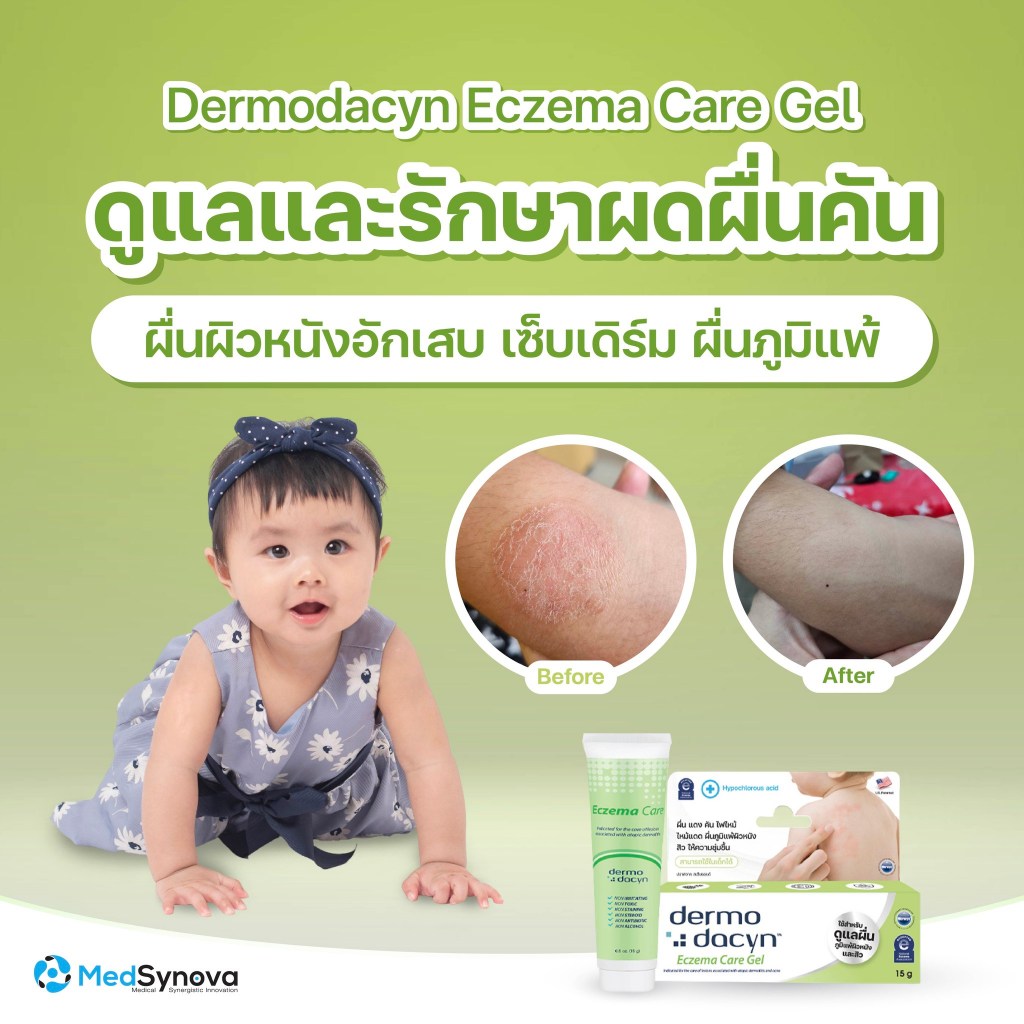 Dermodacyn Eczema Care Gel เดอร์โมดาชิน เอกซีมา แคร์ เจล ลดการอักเสบของ ...