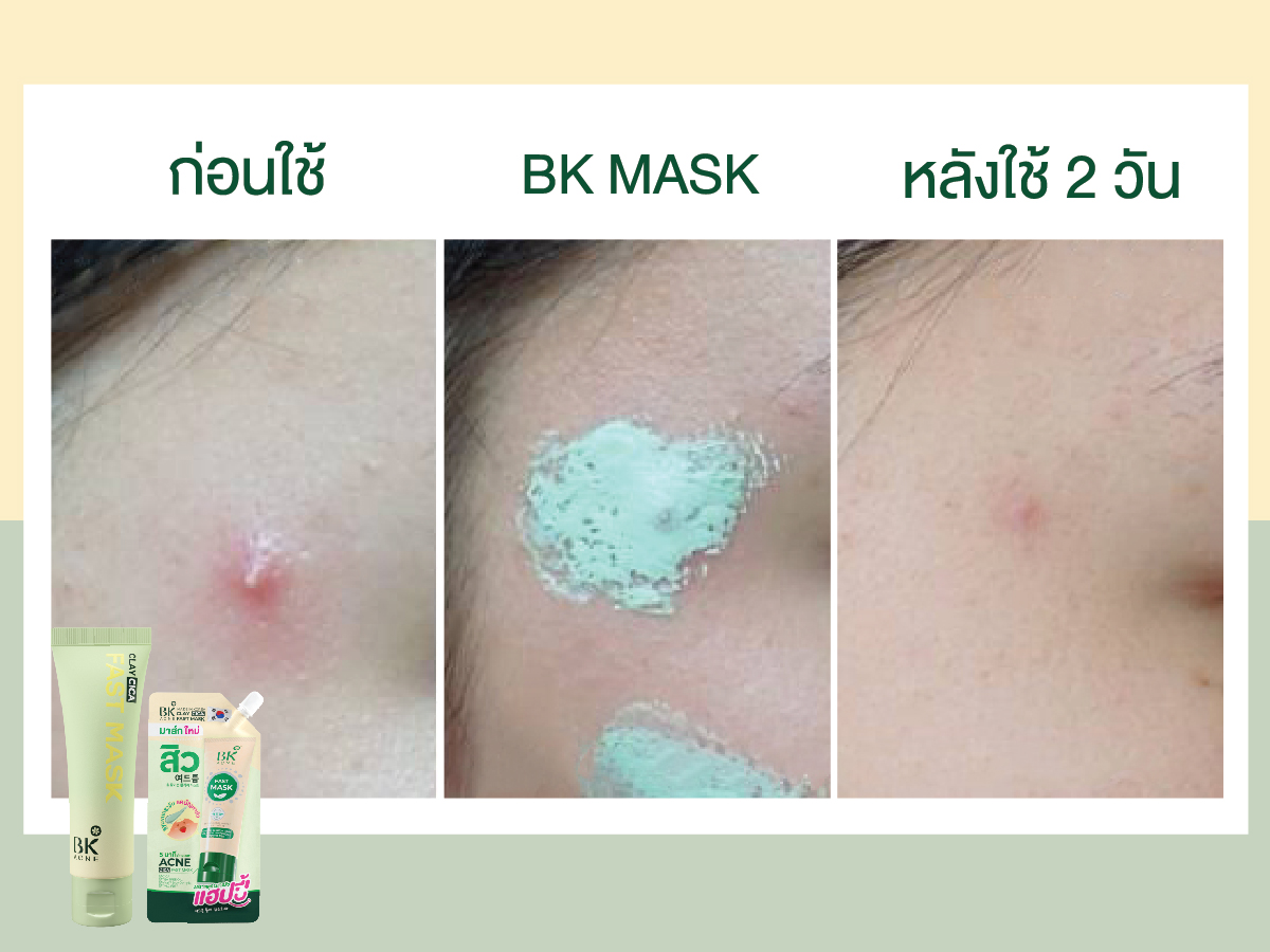 BK ACNE CLAY CICA FAST MASK มาส์กสิว มาส์กหน้าลดสิว ลดความมันมาร์คโคลน ...