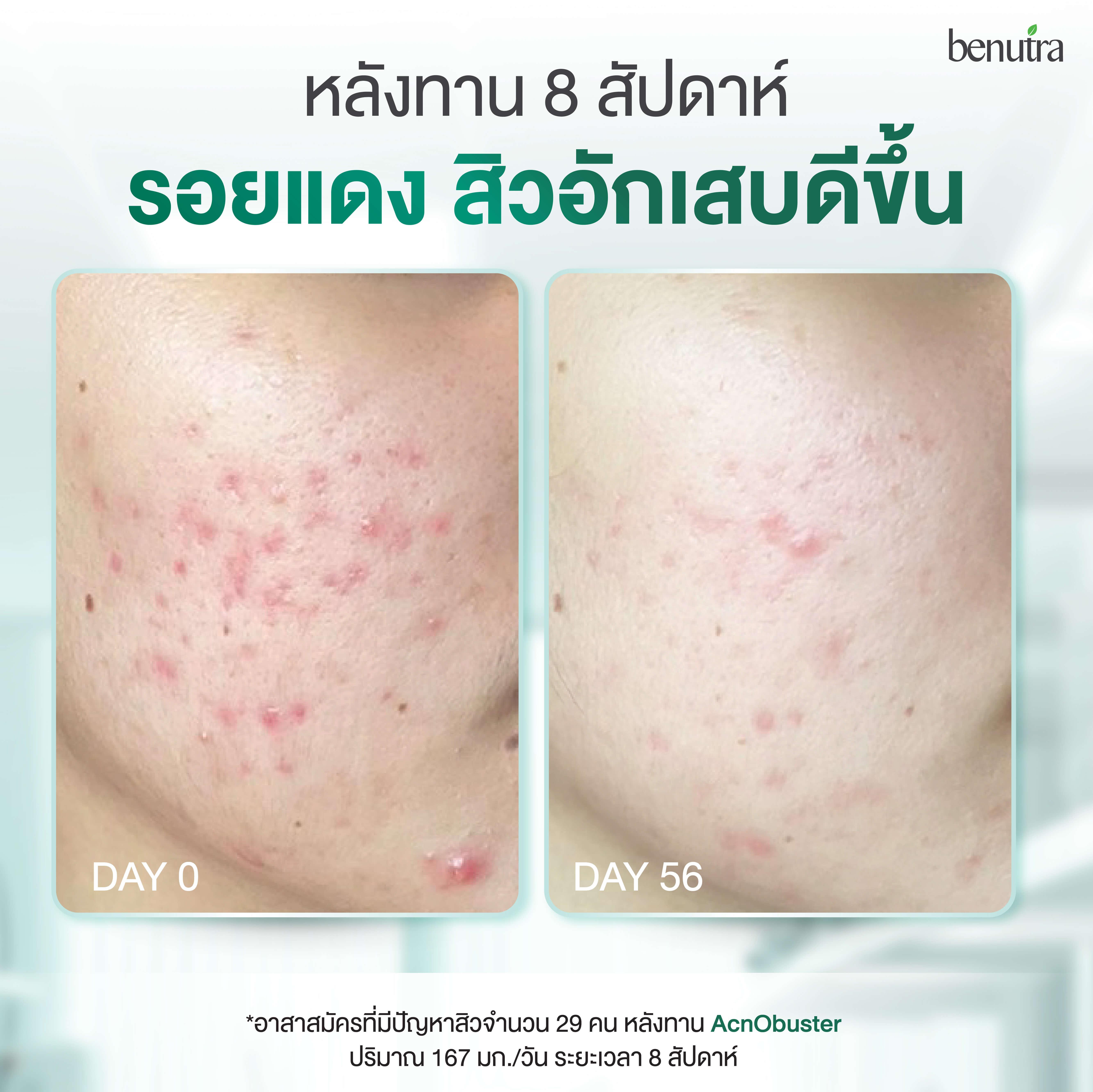 BENUTRA ACNO PRO 1 กระปุก 30 เม็ด บีนูทร่า แอคโน โปร วิตามินลดสิว ซิงค์ ...