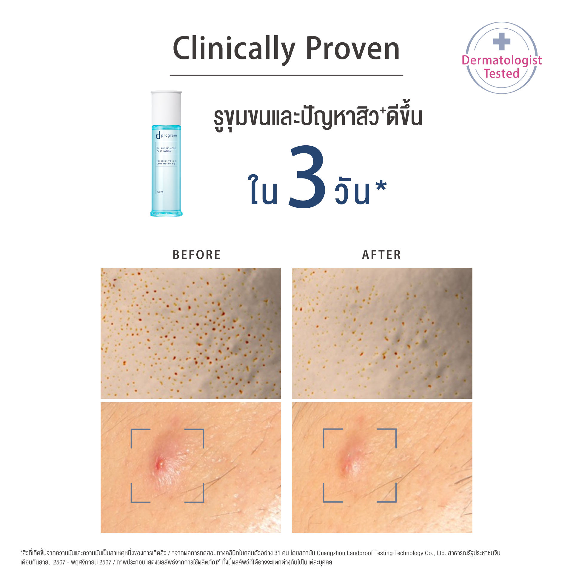 [สูตรใหม่!] d program ดี โปรแกรม บาลานซิ่ง แอคเน่ แคร์ อิมัลชั่น 100 mL ...