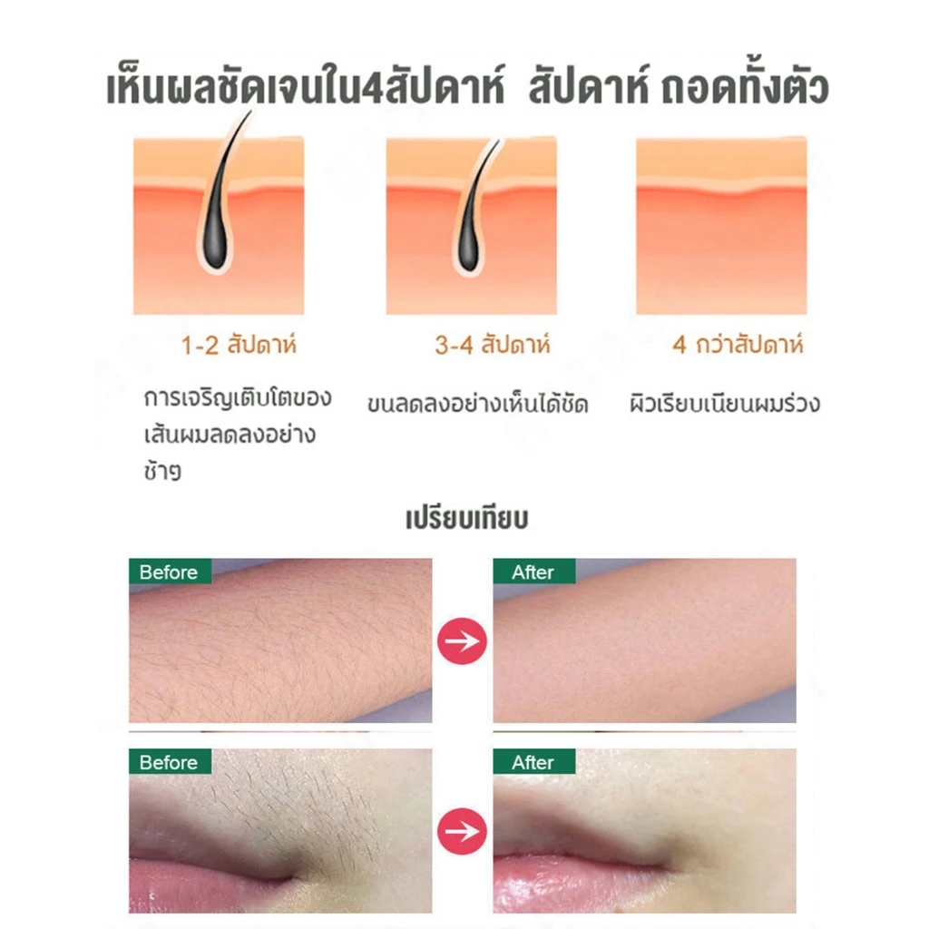 【รับประกัน 1 ปี】GEN3 IPL Whtie Gold Laser Removal (999,999 Shot) Multi ...