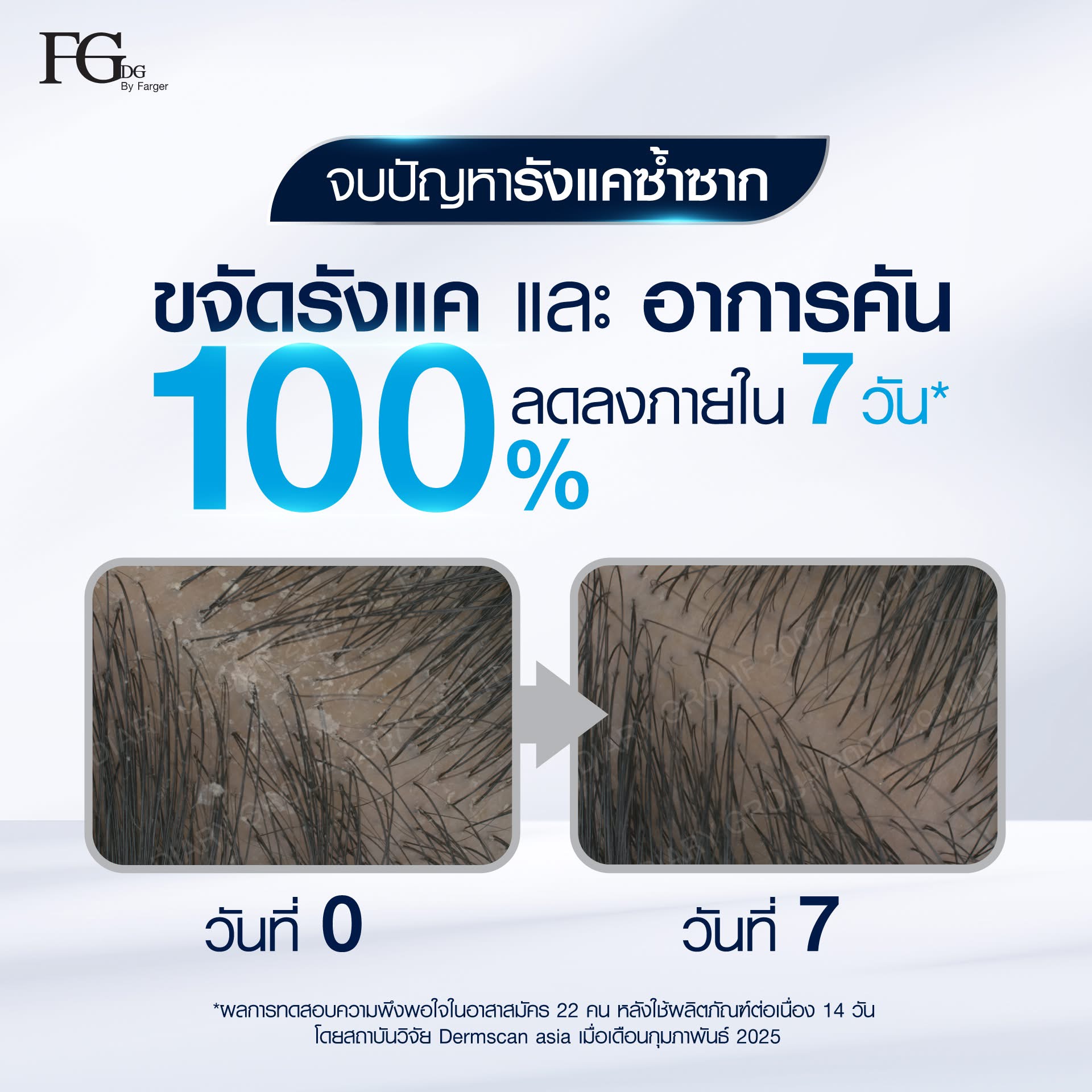 FGDG DUO CLEAR ANTI-DANDRUFF SHAMPOO SET แชมพูสูตรพิเศษสำหรับผู้ที่มี ...